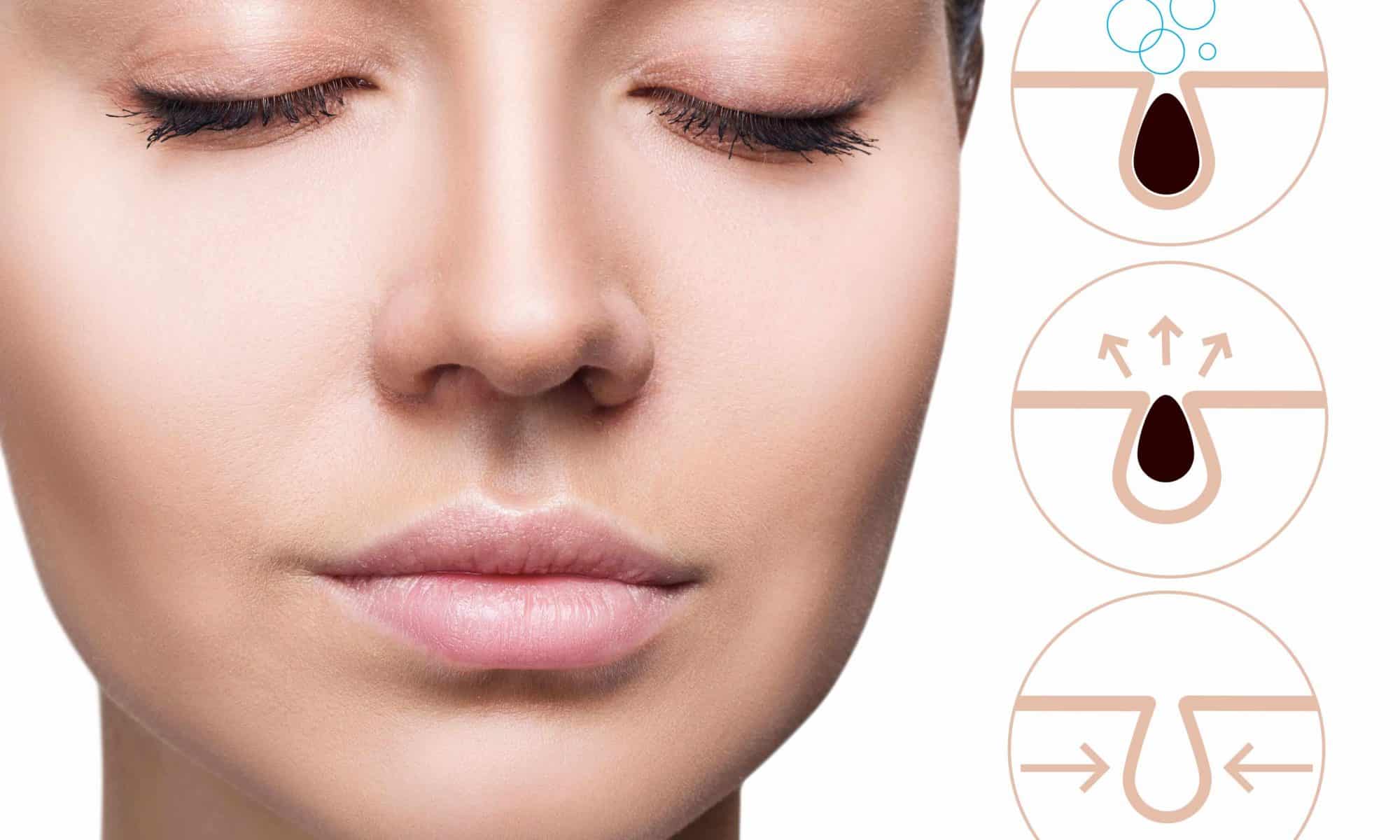 5 Tips to manage open pores